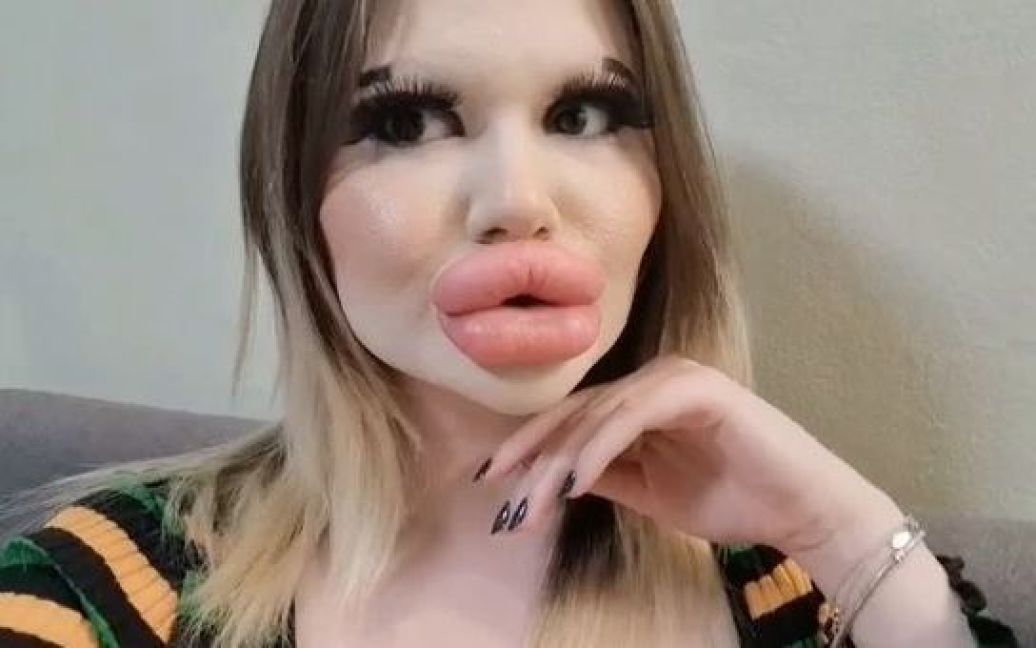 Женщина с самыми большими в мире губами решила изменить еще одну часть лица: как она выглядит