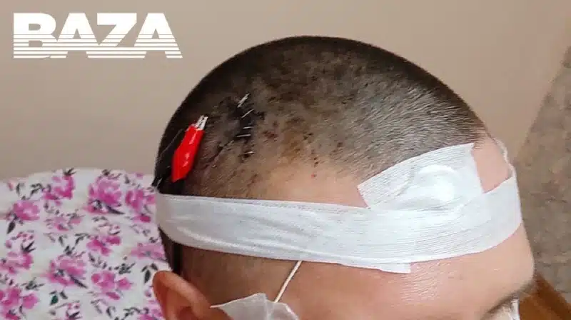 Чипировал мозг: в Алматы россиянин просверлил себе дрелью череп