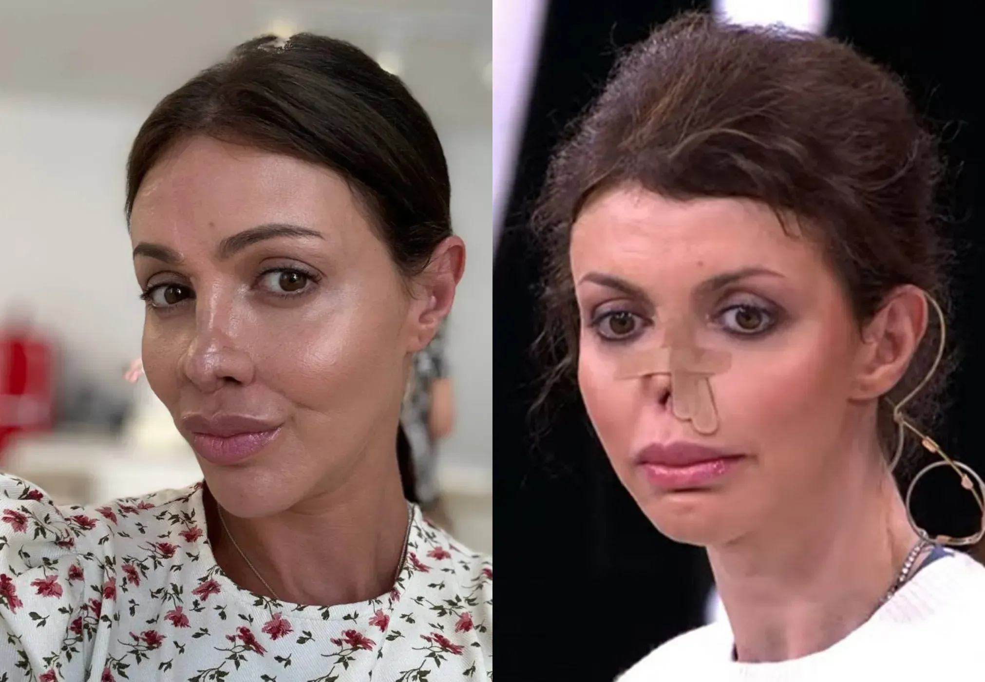 Как укол красоты разрушил жизнь Алисы Аршавиной